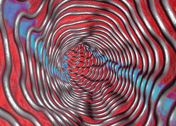 A digital design of a new dissolving stent