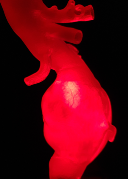 A ballooning aorta (aneurysm)