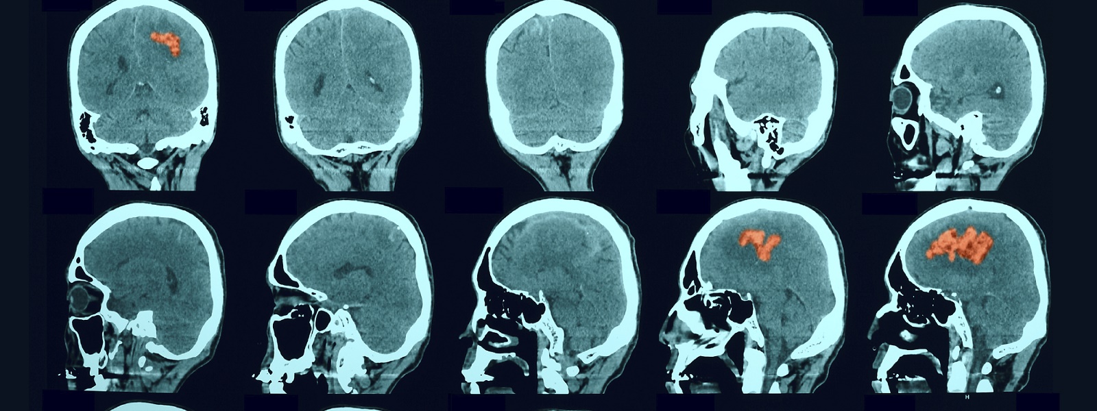 CT scan of the brain. Hemorrhagic stroke