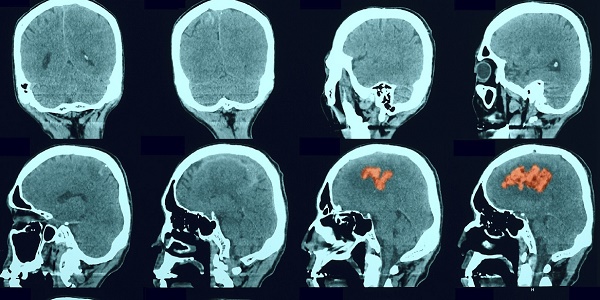 CT scan showing stroke 