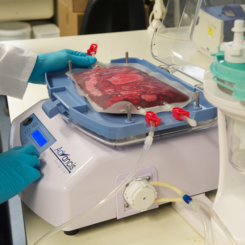 Person wearing surgical gloves uses a Advancis Surgical device with a blood bag on top of the device.